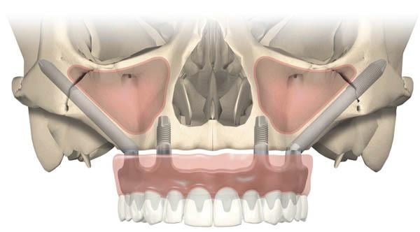 Zygomatic dental implants