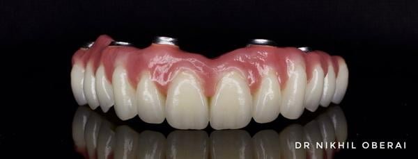 Full Arch Dental Implants Dr Nikhil Oberai