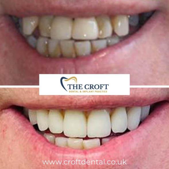 Dental Implants before and after 1