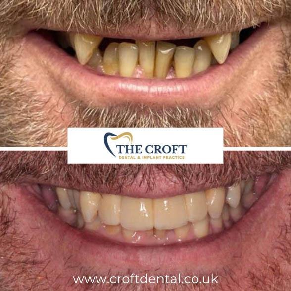 Dental Implants before and after 3