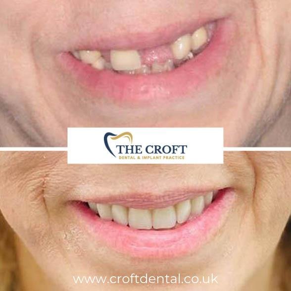 Dental Implants before and after 4