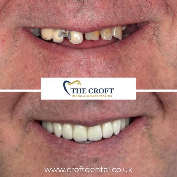 Dental Implants before and after 5