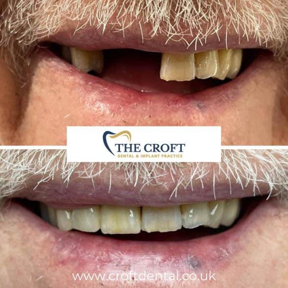 Dental Implants before and after 6