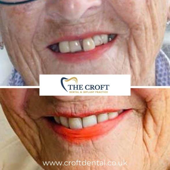 Dental Implants before and after 7