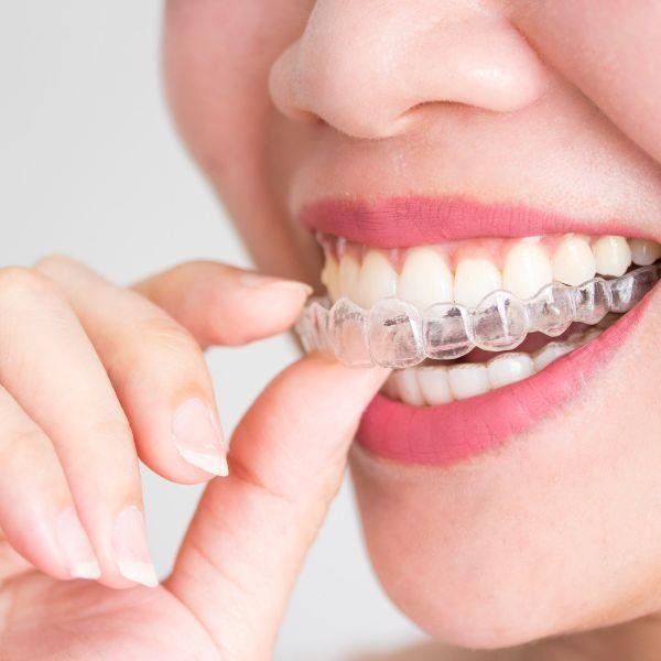 Invisalign Wilmslow