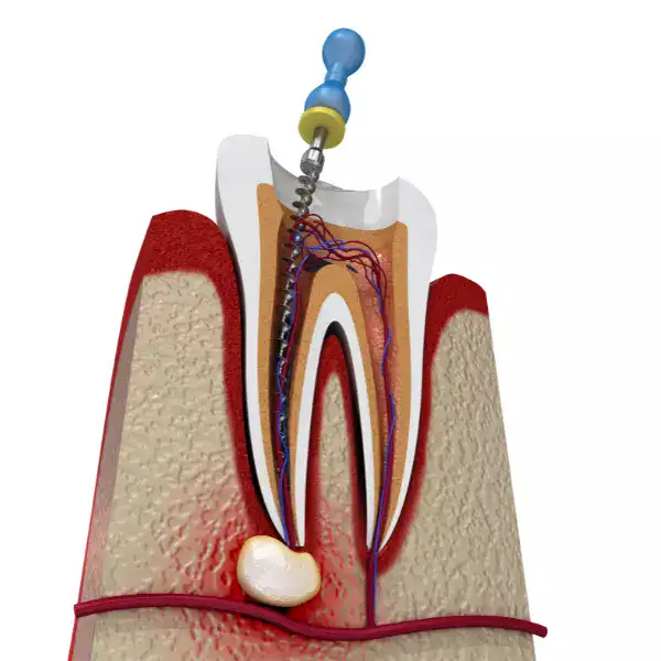 Root Canal Wilmslow