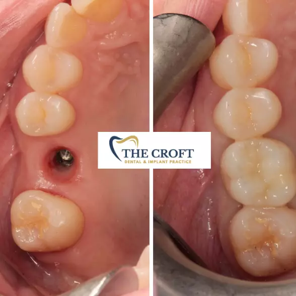 Implant before & after