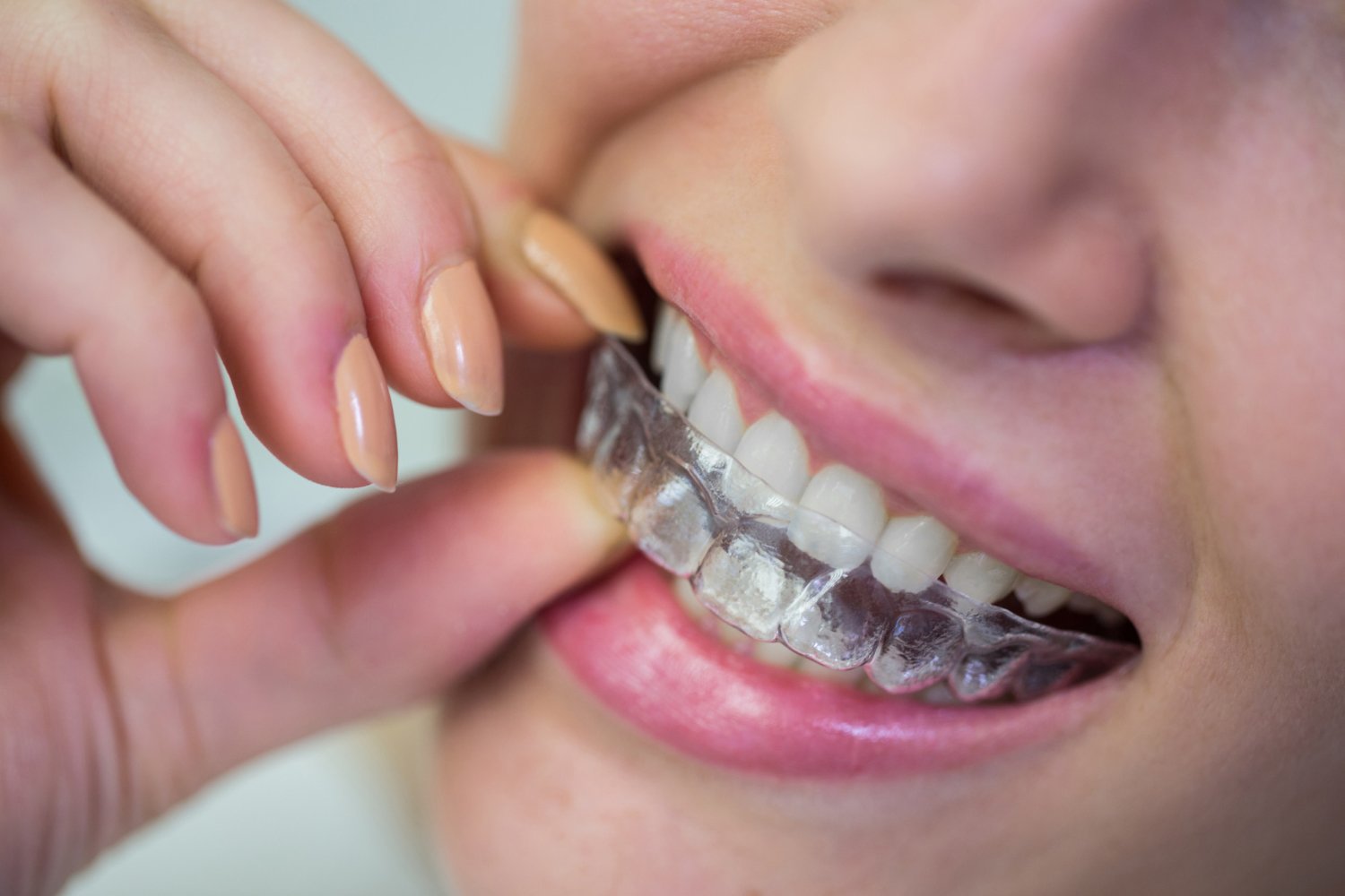 Invisalign Invisalign