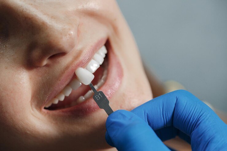Dental Implants Dental Implants