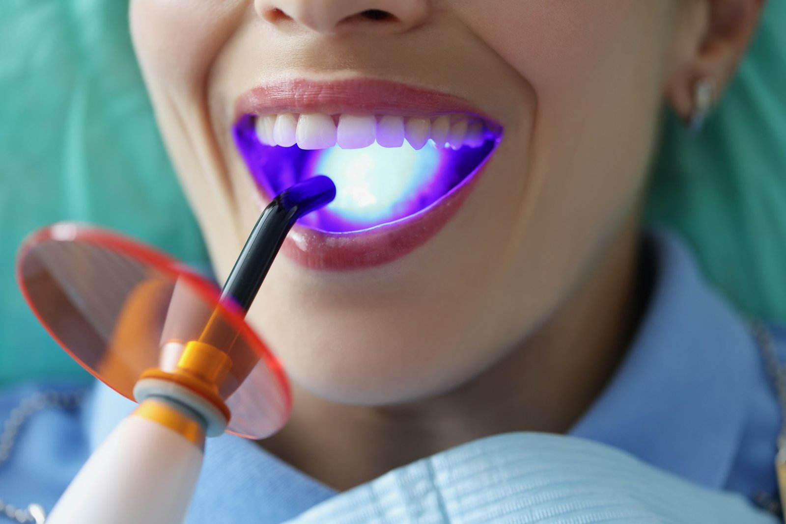 Composite Bonding